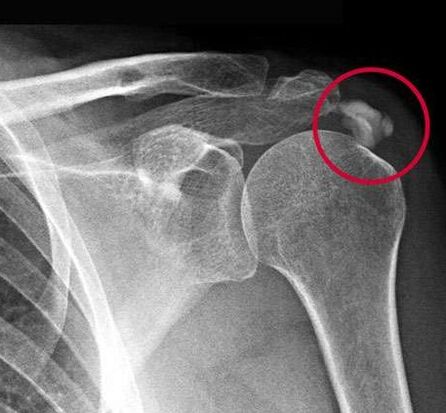 La radiographie a montré des dépôts de sels de calcium dans l'articulation