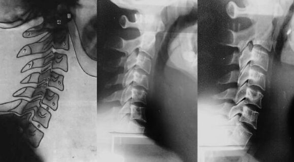 Cou avec un décalage des premières vertèbres cervicales