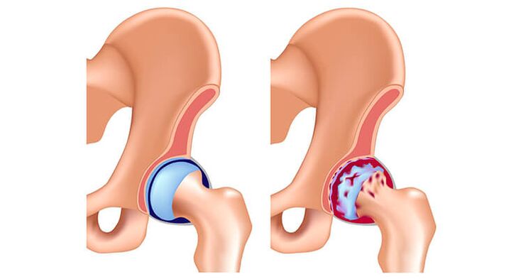 Arthrose de l'articulation de la hanche